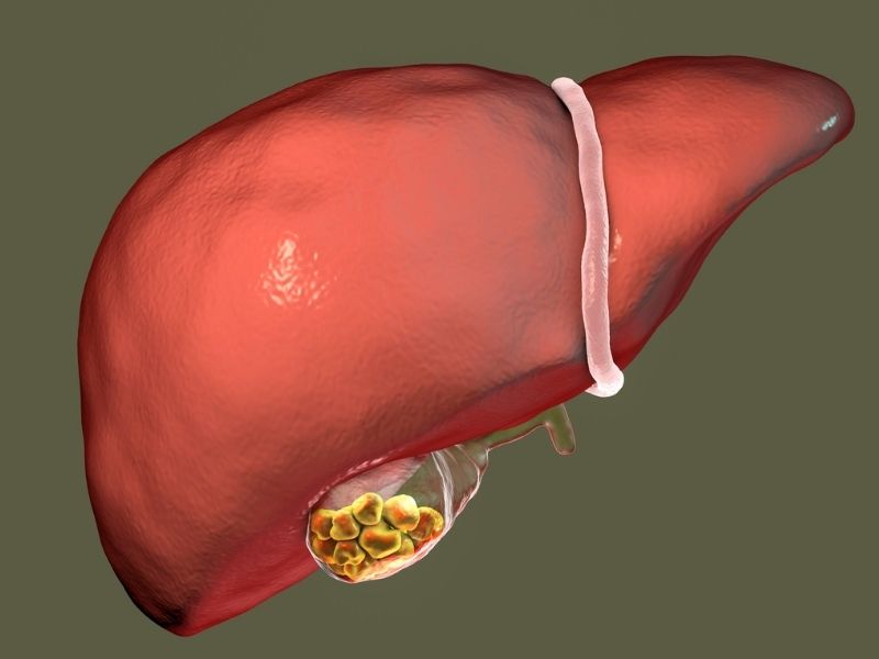 safra-kesesi-ameliyati-sonrasi