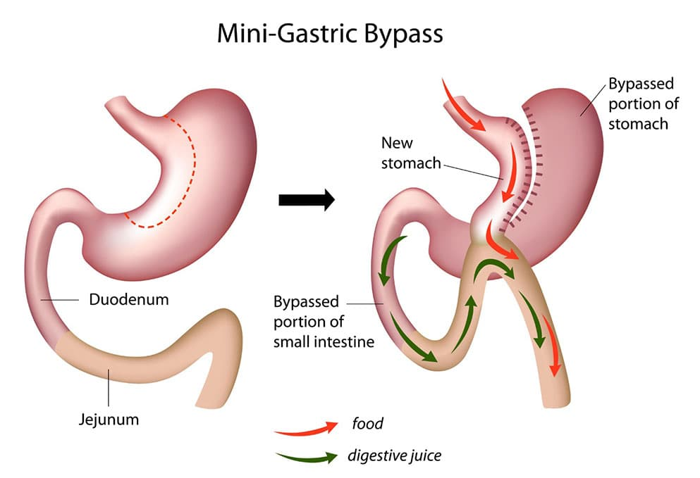 Gastrik Bypass